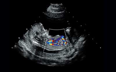 Fetal Echocardiogram (Fetal ECHO) Ultrasound
